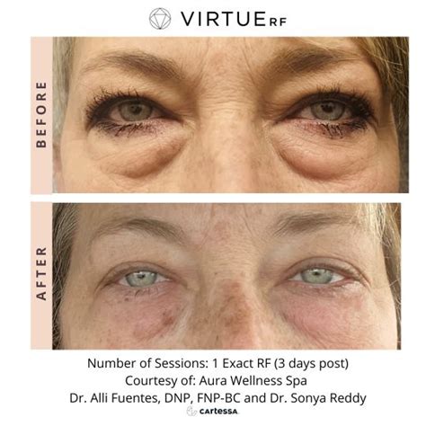 Virtue RF Microneedling In Columbia SC Wrinkle Reduction