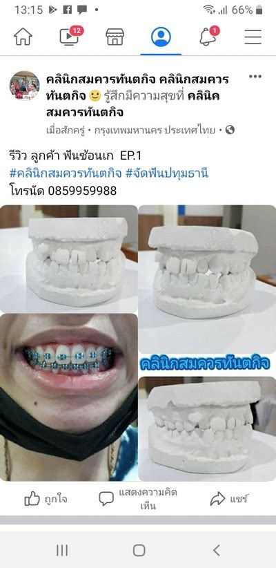 รีวิว คลินิกสมควรทันตกิจ ตัวอย่าง เคสจัดฟัน คลินิกสมควรทันตกิจ0859959988