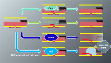 Gel Immersion Endoscopygel Immersion Endoscopy