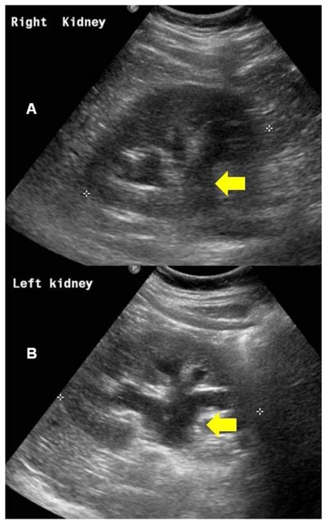 Nephrostomy Tube Ultrasound