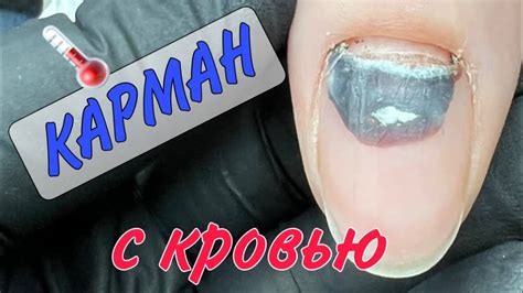 Гематома под ногтем/ травма ногтя/ кровь под ногтем - YouTube