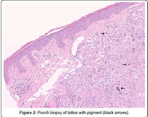 Sarcoid Granuloma Tattoo Tanivienne