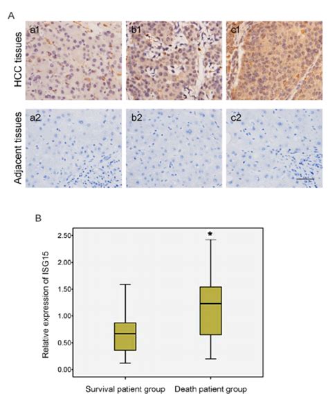 Expression Of Isg Is Related To Hcc Histologic Differentiation And