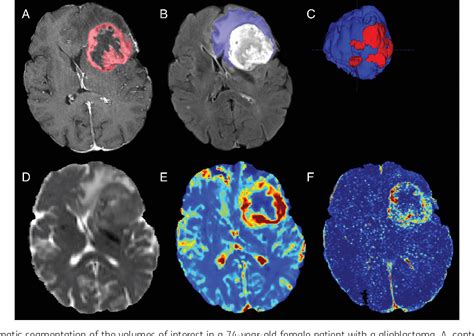 Figure 1 From Clinical Parameters Outweigh Diffusion And Perfusion