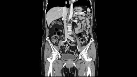 Smt Submucosal Tumor Stomach Youtube