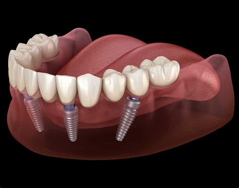 Tampa Dental Implants Muscaro Martini 813 547 5168