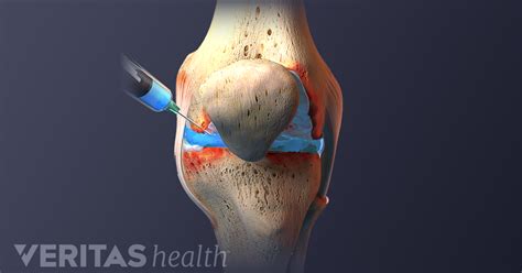 Efficacy Of Platelet Rich Plasma Injections