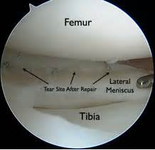 Torn Meniscus Surgery Video Jeffrey H Berg M D