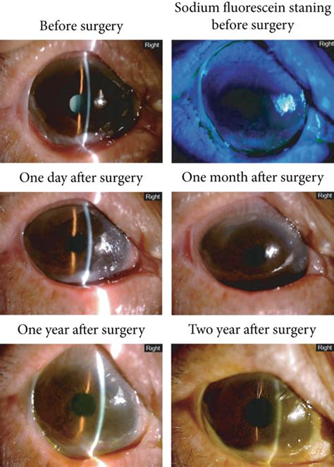 The Anterior Segment Image Of The Second Patient In The OCP Stage Of