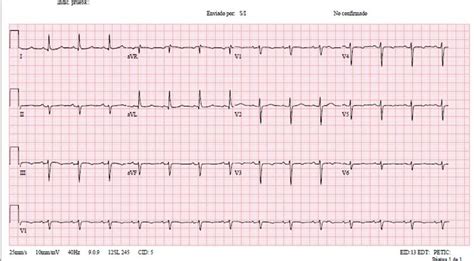 1 Ablacion Programada Taquicardia Paroxistica Supraventricular Ecg TPSV