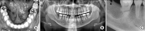 Figure From Surgical And Orthodontic Treatment Of Unicystic