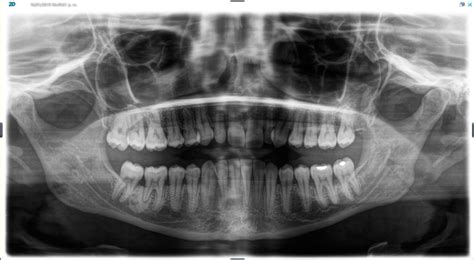 Bitewing X Rays Purpose Types And Safety Dentist In Tijuana