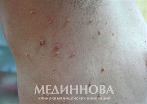 Удаление папиллом в Москве