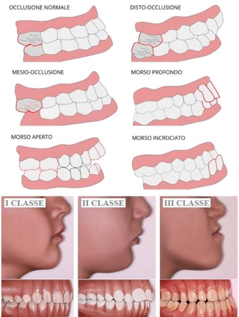 Malocclusione Dentale Diagnosi Sintomi E Rimedi Valentina Marrone