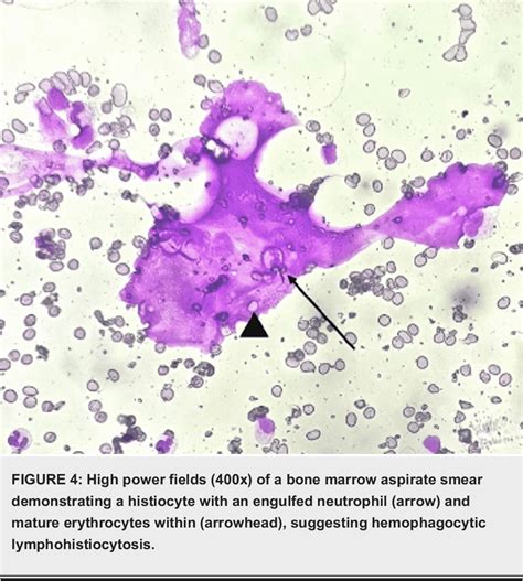 Figure 4 From A Case Report Of Hemophagocytic Lymphohistiocytosis HLH