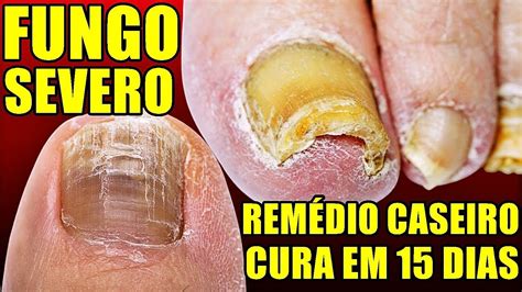 Receita Para Curar Fungos Nas Unhas Onicomicose Vai Matar Toda Micose