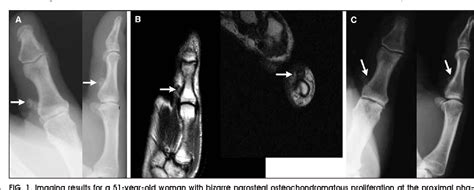 Figure From Bizarre Parosteal Osteochondromatous Proliferation Nora