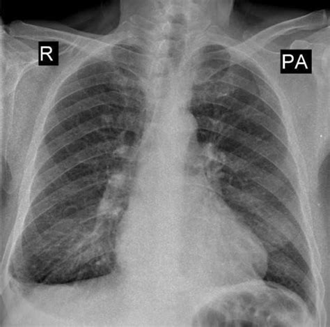 Chest X-ray after surgery. | Download Scientific Diagram