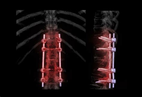 Lateral Interbody Fusion Hart Garner MD Minnesota Spinal Neurosurgeon