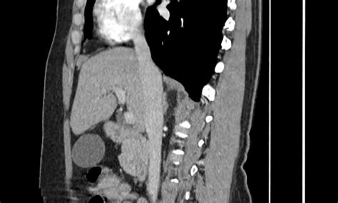 Annular Pancreas Radiopaedia B Nc Commons