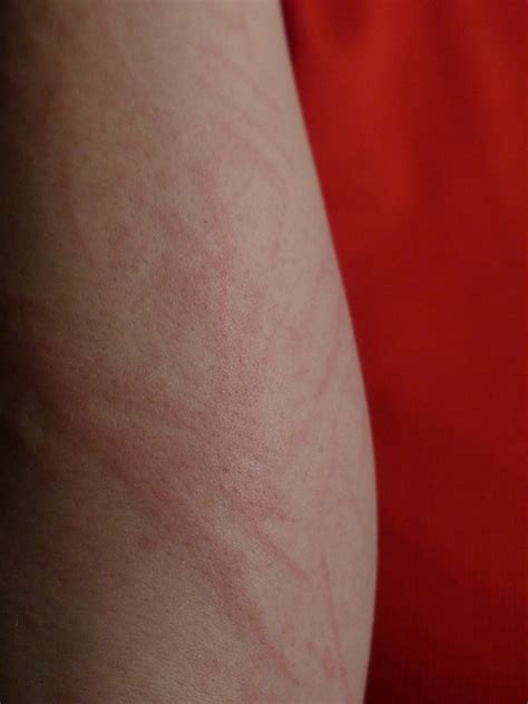 Alergia A Sabão Em Pó - Alergia a sabão em pó sintomas e tratamentos - Fc Noticias