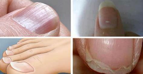 7 Common Nail Conditions Linked To Serious Diseases That You Shouldn’t Ignore Fibromyalgia