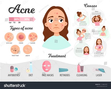 Vektor Stok Acne Types Causes Treatment Infographics Vector Tanpa Hot