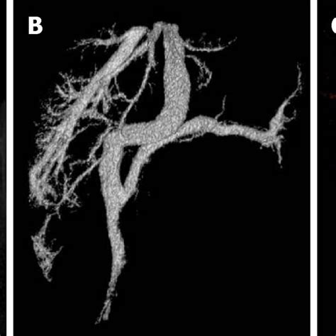 Computed Tomography 3d Reconstruction And Portal Vein Image Download Scientific Diagram