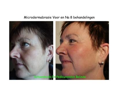 Microdermabrasie Schoonheidssalon En Medisch Pedicure Belinda