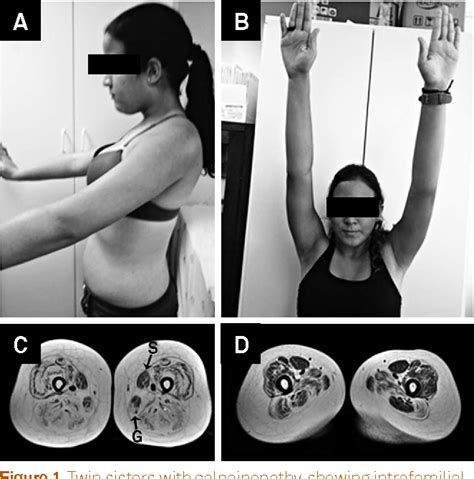 Figure From Limb Girdle Muscular Dystrophy Type A In Brazilian