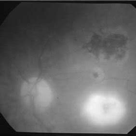 Patient Presenting With Recurrences Of Ocular Toxoplasmosis With Final