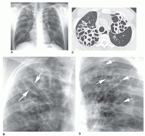 Airway Disease Bronchiectasis Chronic Bronchitis And Bronchiolitis