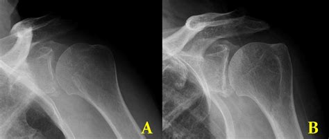 Arthroscopic Fixation Of Iatrogenic Glenoid Rim Fracture Caused By