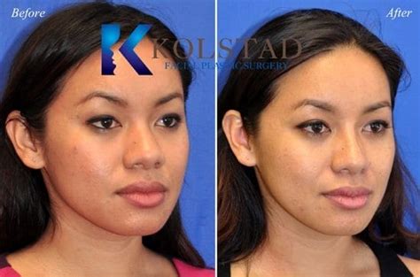 Wide Nose Rhinoplasty Asian