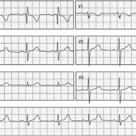 12 Lead Electrocardiogram In Sinus Rhythm Normal Sinus P Waves Normal