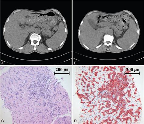 Intravascular Large B Cell Lymphoma Diagnosed Via Transjugul Medicine