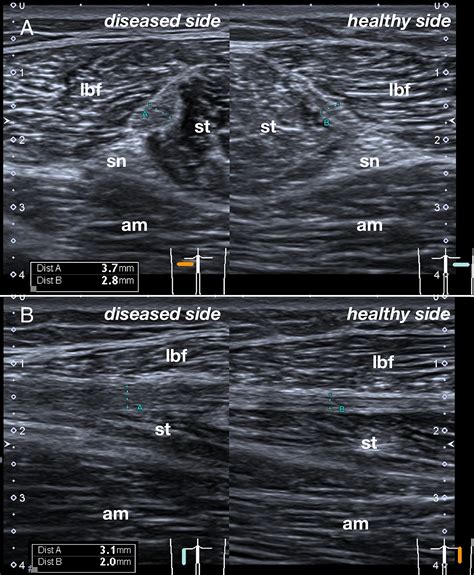 Hamstring Tear Ultrasound