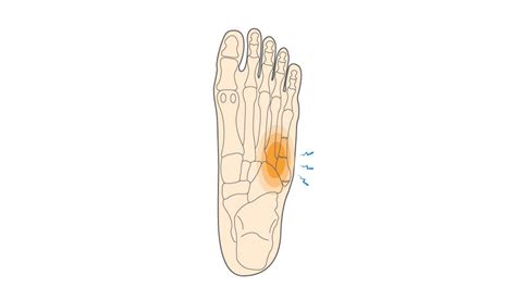 Metatarsal Bone Fracture