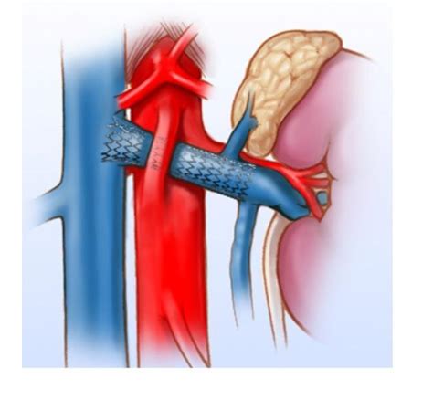 Nutcracker Syndrome Charlotte Nc South Charlotte General And