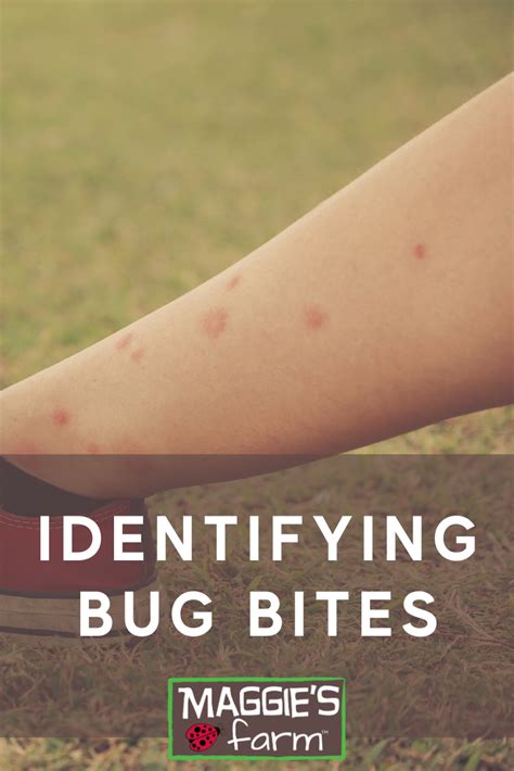 Identifying Bug Bites Identifying Bug Bites Bug Bites Bug Bite Relief