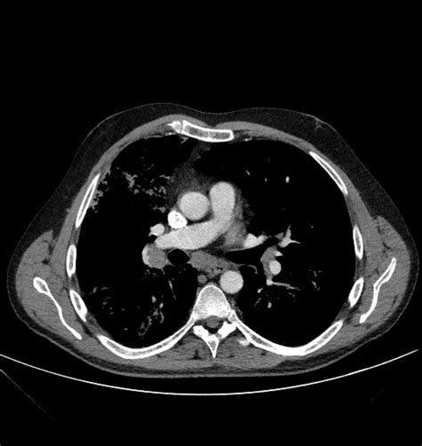 Pulmonary Alveolar Proteinosis Image Radiopaedia Org