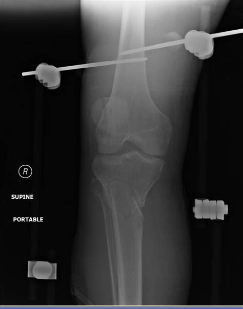 Patella Fracture Wikidoc