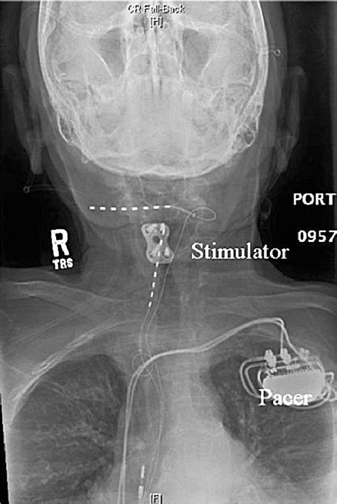 Figure From Successful Treatment Of Occipital Neuralgia With