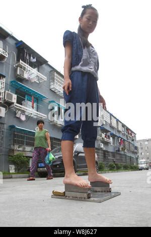 A 13 Year Old Girl Surnamed Xie Displays Her Foot After Standing