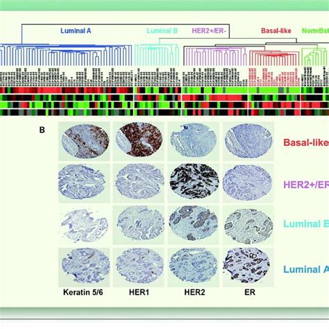 Immunohistochemical Surrogate Assay For Intrinsic Subtypes Of Breast