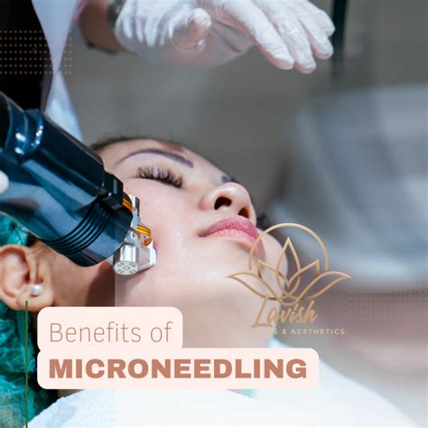 What Are The Benefits Of Microneedling Lavish Wellness Blog