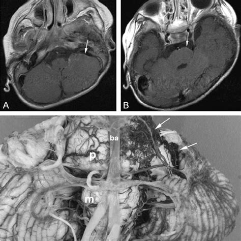 Pial Angioma Involving Both Supra And Infratentorial Compartments A