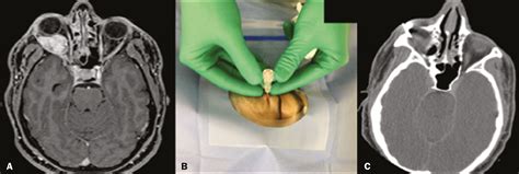 Scielo Brasil Computed Tomography Guided Percutaneous Biopsy Of