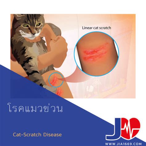 Cat Scratch Disease Jia1669