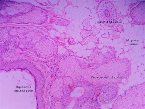 Dermoid Cyst Ovary Histopathologyguru